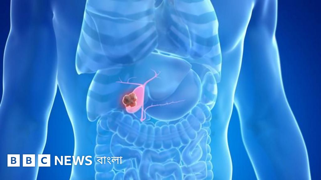 পিত্তথলিতে পাথর: কারণ, শনাক্তকরণ ও চিকিৎসা পদ্ধতি