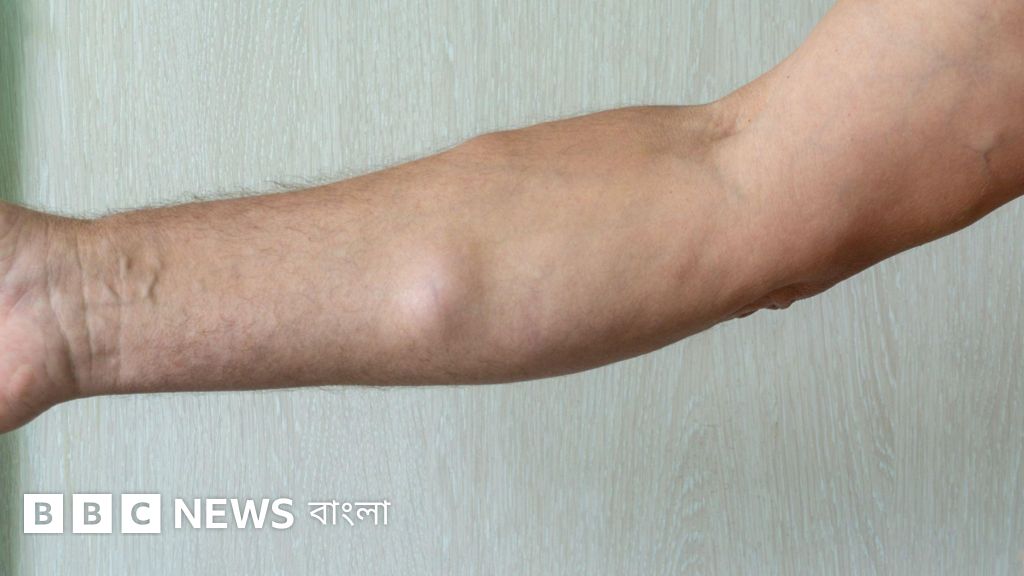 শরীরে চর্বির দলা 'লাইপোমা': এটি কি ক্যান্সারের ঝুঁকি বাড়ায়?